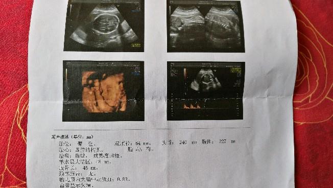 六个月彩超单，揭示胎儿成长的关键之旅